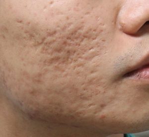 eliminacion cicatrices de acne secuelas quito